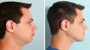 Jawline Dolgusu Nedir Jawline Nasıl Yapılır?