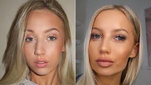 Jawline Dolgusu Nedir Jawline Nasıl Yapılır?