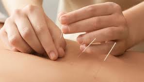 Elektro Akupunktur Nedir, Nasıl Uygulanır?