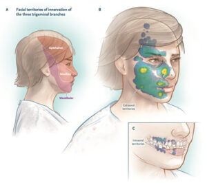 Trigeminal Nevralji Delirten Hastalık Nedir, Tedavisi Var Mı?