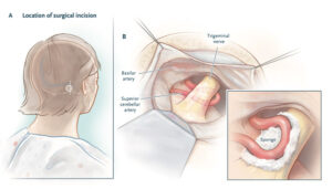 Trigeminal Nevralji Delirten Hastalık Nedir, Tedavisi Var Mı?