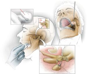Trigeminal Nevralji Delirten Hastalık Nedir, Tedavisi Var Mı?