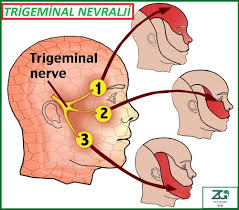 Trigeminal Nevralji Delirten Hastalık Nedir, Tedavisi Var Mı?