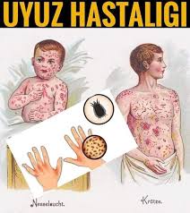 Uyuz Hastalığı ve Belirtileri nelerdir?