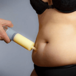 Liposuction