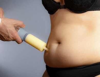 Liposuction